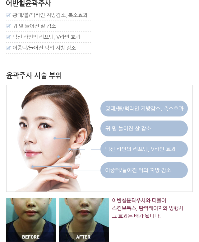 윤곽주사